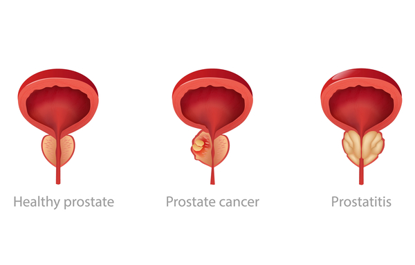 prostate